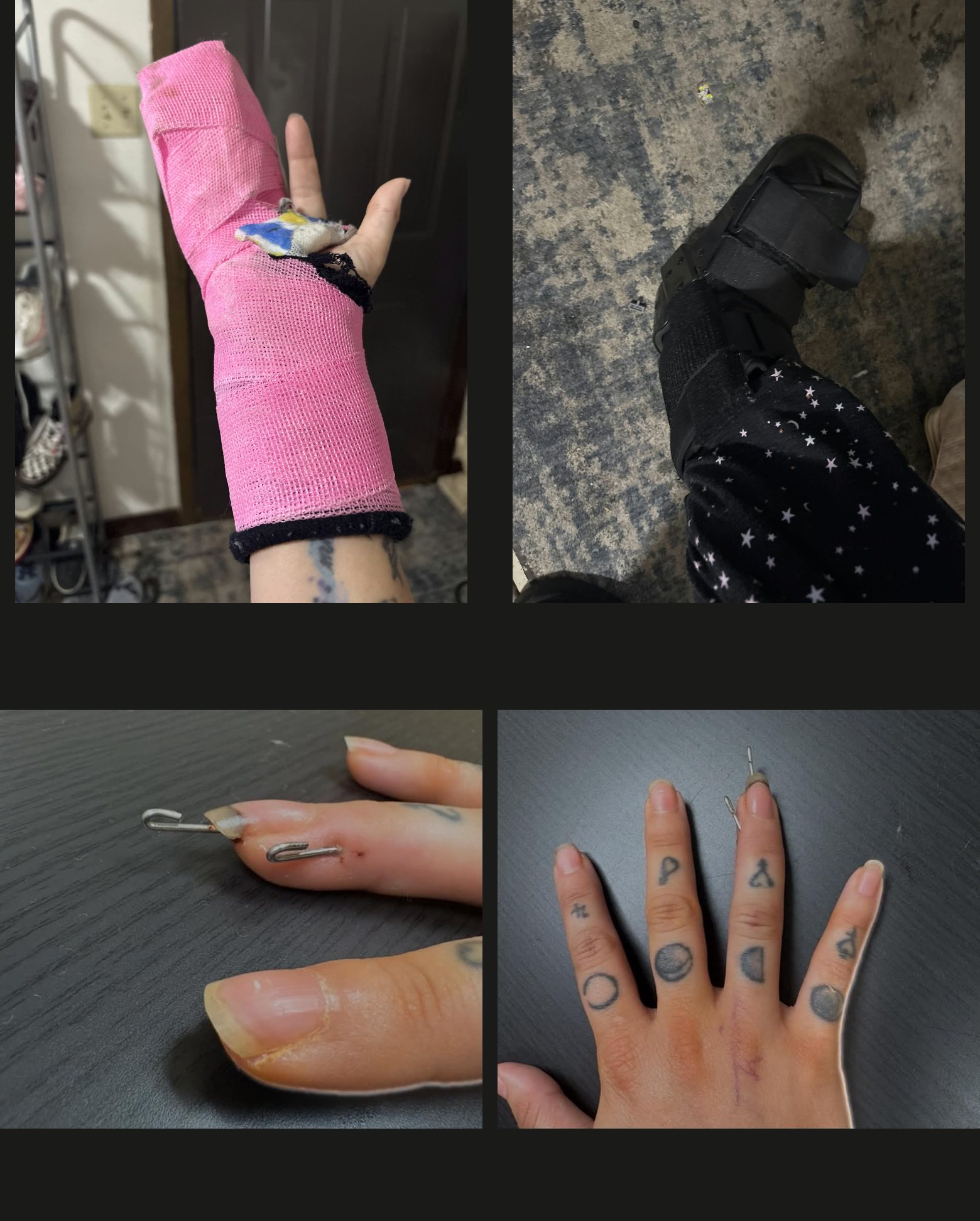 Four photographs: a right hand in a bright pink cast running from the forearm past the fingers, a right foot in a black walking boot, and two close frames of surgical pins through the fingers.