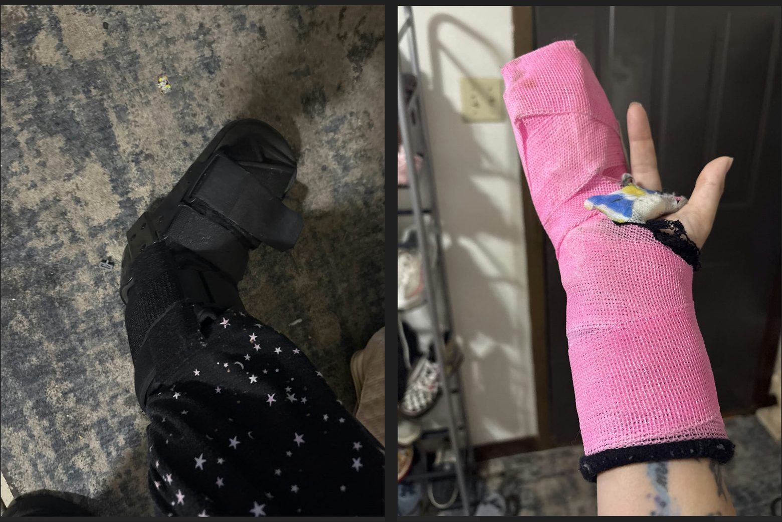 Two photographs: the resident's right hand in a bright pink cast, and her right foot in a walking boot.